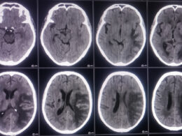 "CT scan showing eight axial cross-sections of a human brain. The images appear to depict a large mass effect on the right hemisphere, consistent with a possible meningioma. The tumor causes midline shift, compression of the lateral ventricle, and surrounding edema. The scan may be used to illustrate the presence of a brain tumor and its potential impact on nearby structures