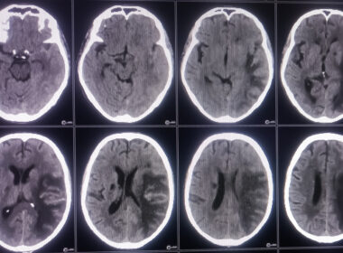 "CT scan showing eight axial cross-sections of a human brain. The images appear to depict a large mass effect on the right hemisphere, consistent with a possible meningioma. The tumor causes midline shift, compression of the lateral ventricle, and surrounding edema. The scan may be used to illustrate the presence of a brain tumor and its potential impact on nearby structures